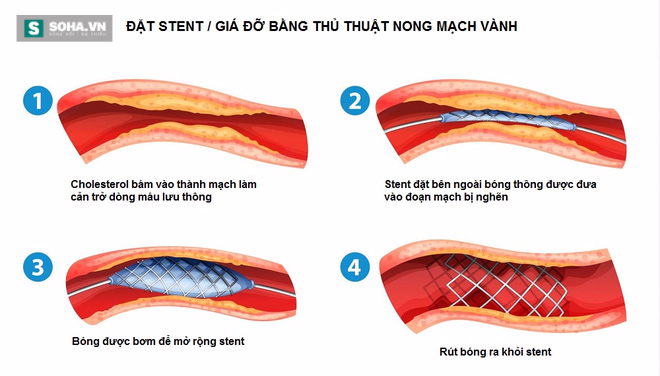 6 thực phẩm đặc trị dành cho người sợ bệnh tắc nghẽn mạch máu - Ảnh 1. 6 thực phẩm đặc trị dành cho người sợ bệnh tắc nghẽn mạch máu - Ảnh 1.