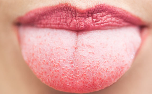 Những dấu hiệu cảnh báo ở lưỡi, đặc biệt lưu ý về nhiều bệnh ung thư