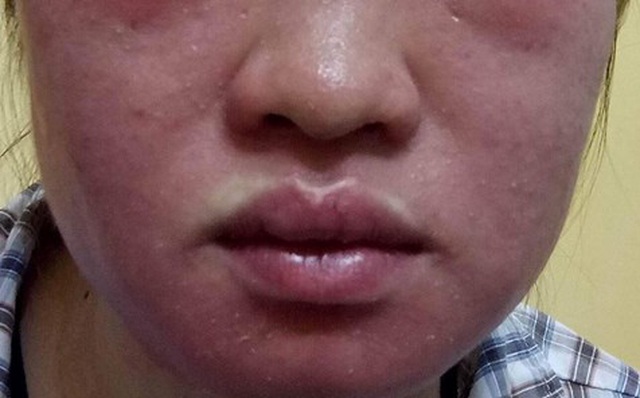Mặt “biến dạng” vì thần dược siêu trắng da Mặt “biến dạng” vì thần dược siêu trắng da