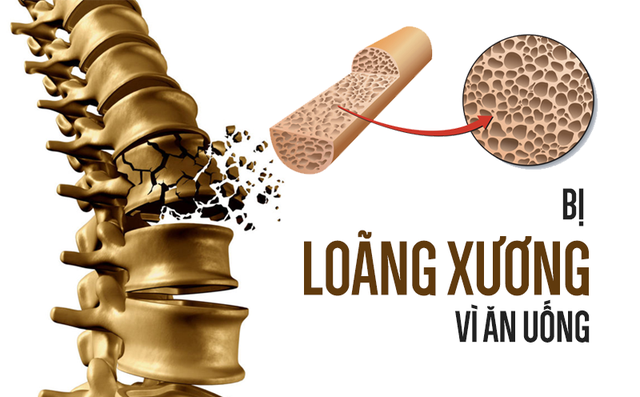5 cách ăn uống "hủy hoại" xương nhanh chóng: Nếu kéo dài thì hậu quả sẽ rất nghiêm trọng 5 cách ăn uống "hủy hoại" xương nhanh chóng: Nếu kéo dài thì hậu quả sẽ rất nghiêm trọng