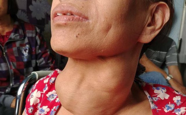 Dù ăn rất mặn nhưng người Việt vẫn thiếu i ốt tồi tệ nhất thế giới: Đâu là nguyên nhân? Dù ăn rất mặn nhưng người Việt vẫn thiếu i ốt tồi tệ nhất thế giới: Đâu là nguyên nhân?