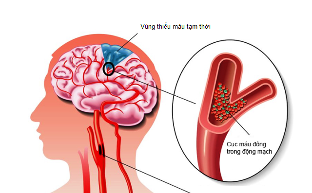 Hẹp van tim - “Thủ phạm” gây biến chứng chết người ít ai biết Hẹp van tim - “Thủ phạm” gây biến chứng chết người ít ai biết