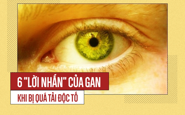 6 dấu hiệu cảnh báo gan đang bị "nhồi" đầy độc tố: Không can thiệp sớm sẽ dễ gặp nguy hiểm 6 dấu hiệu cảnh báo gan đang bị "nhồi" đầy độc tố: Không can thiệp sớm sẽ dễ gặp nguy hiểm