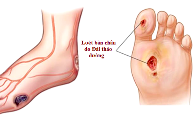 6 nhóm người có nguy cơ cao mắc tiểu đường: Đừng thờ ơ vì bệnh sẽ cắt giảm tuổi thọ của bạn 6 nhóm người có nguy cơ cao mắc tiểu đường: Đừng thờ ơ vì bệnh sẽ cắt giảm tuổi thọ của bạn