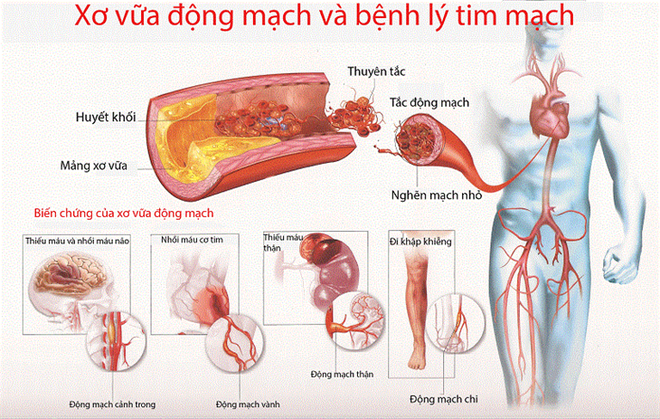 Sát thủ thầm lặng gây bệnh nhồi máu cơ tim, huyết áp - Ảnh 2.