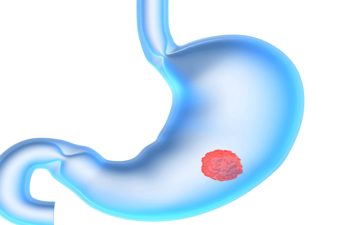 5 dấu hiệu phát hiện ung thư dạ dày sớm, đừng để có triệu chứng rõ ràng khi đó đã muộn