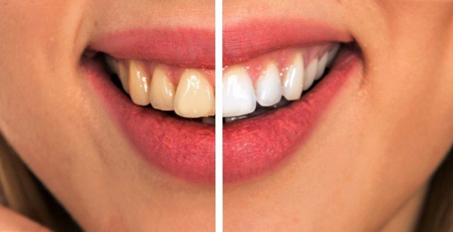 8 mẹo vặt hữu ích giúp bạn luôn nói không với bệnh sâu răng - Ảnh 4.