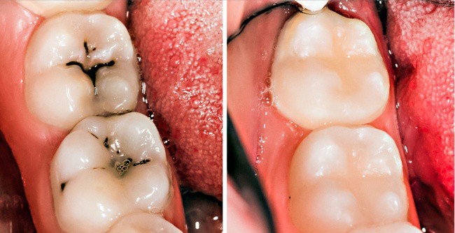8 mẹo vặt hữu ích giúp bạn luôn nói không với bệnh sâu răng - Ảnh 5.