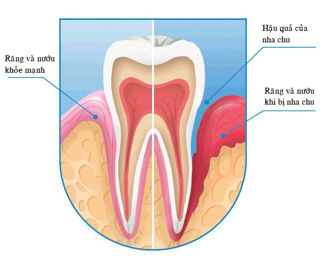 Phương pháp chữa sâu răng 100% tự nhiên rất dễ áp dụng tại nhà  - Ảnh 3.