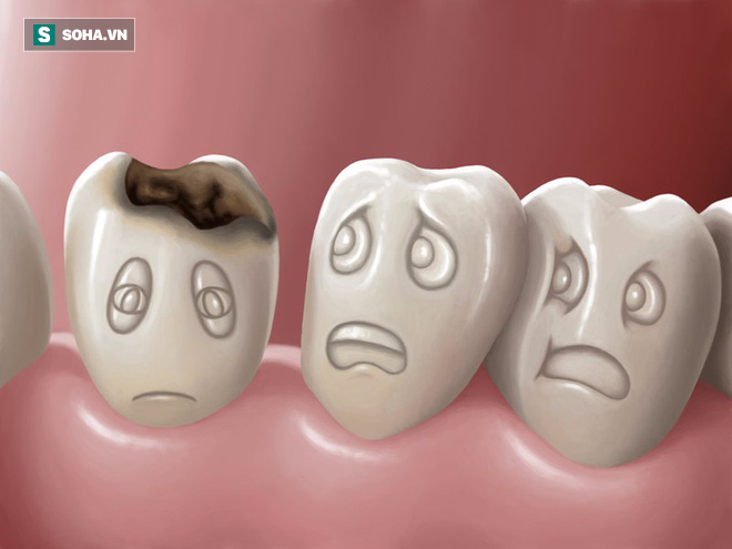 Phương pháp chữa sâu răng 100% tự nhiên rất dễ áp dụng tại nhà  - Ảnh 1.