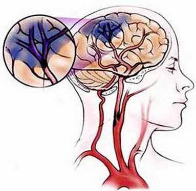 Làm sao biết bị thiếu máu não? - Ảnh 1. Làm sao biết bị thiếu máu não? - Ảnh 1.