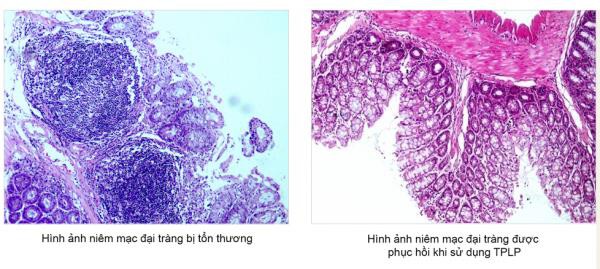 Tràng Phục Linh Plus - Đột phá mới hỗ trợ điều trị viêm đại tràng co thắt của người Việt - Ảnh 3. Tràng Phục Linh Plus - Đột phá mới hỗ trợ điều trị viêm đại tràng co thắt của người Việt - Ảnh 3.