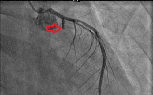 Cảnh giác với nhồi máu cơ tim ở người trẻ - Ảnh 1.