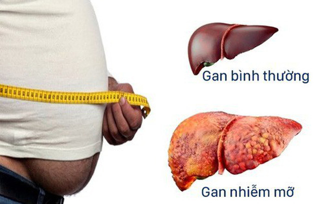 Chớ xem thường gan nhiễm mỡ - Ảnh 1.