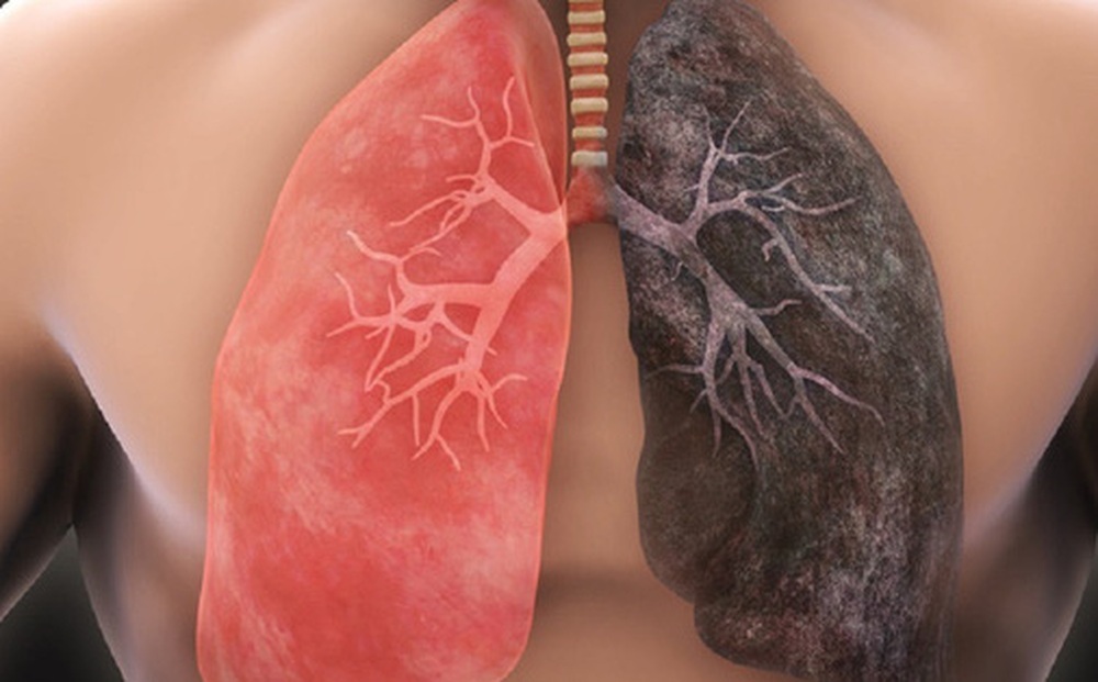 Ung thư phổi không đáng sợ nếu biết rõ nguyên nhân và cách phòng ngừa