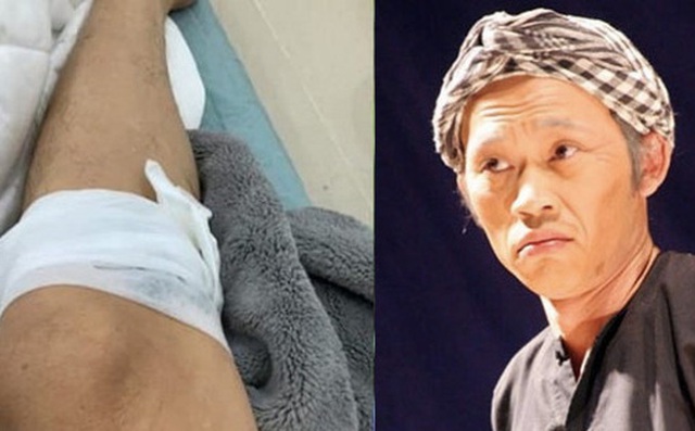 Hoài Linh gặp tai nạn chảy máu chân vì bị gà đá khiến khán giả 'dở khóc dở cười' Hoài Linh gặp tai nạn chảy máu chân vì bị gà đá khiến khán giả 'dở khóc dở cười'
