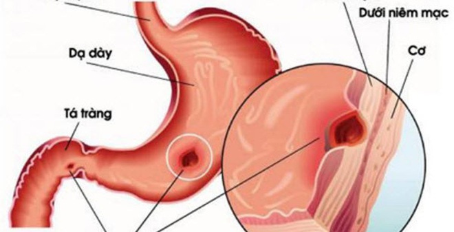 7 bí quyết bảo vệ dạ dày hiệu quả nhất ai cũng nên biết