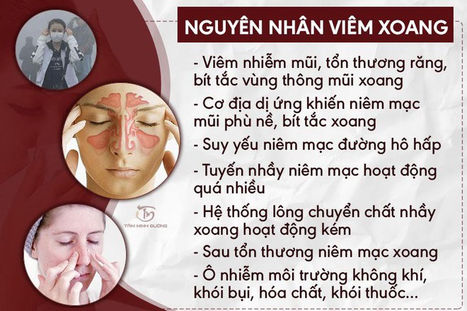 Viêm xoang là gì? Cách chữa bệnh viêm xoang mũi, sàng, hàm, cấp - Ảnh 1.