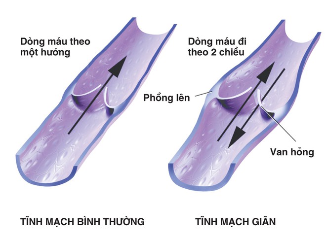 3 bệnh lý mạch máu nguy hiểm không thể bỏ sót - Ảnh 2. 3 bệnh lý mạch máu nguy hiểm không thể bỏ sót - Ảnh 2.